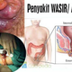 Illustration for article titled cara menghilangkan benjolan bekas wasir ambeien dengan cepatem/em